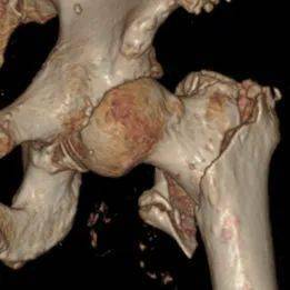 骨折两周后注意事项