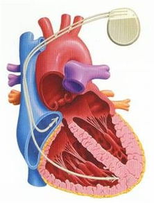 永久起搏器术后注意事项,胶囊起搏器术后注意事项,安装起搏器术后注意事项