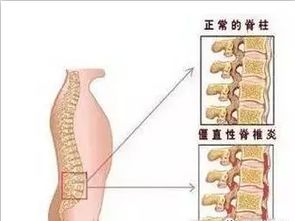脊柱性关节炎注意事项