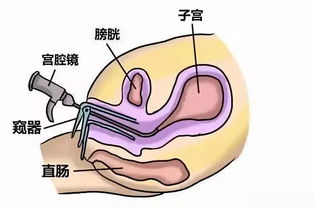 宫腔镜通液后饮食注意事项