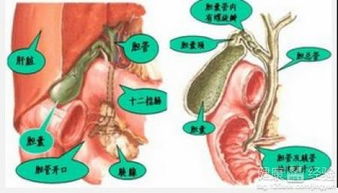 胆肾结石饮食注意事项