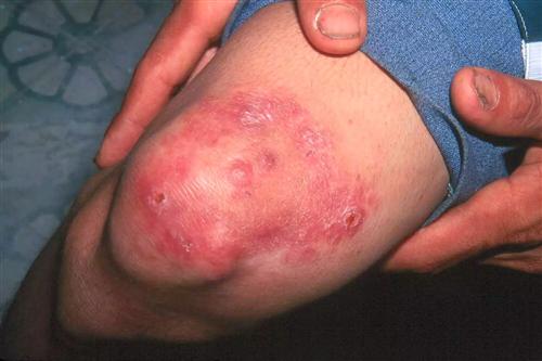 麻风,麻疹,疫苗,注意事项