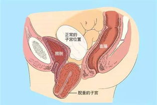 做子宫脱垂修补术后注意事项