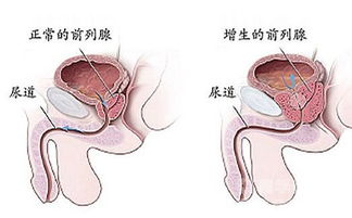 化疗,注意事项,前列腺癌