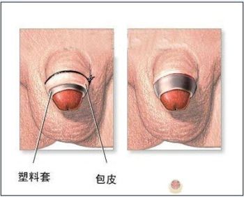 包皮环切器切除后注意事项