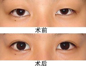 眼睛矫正后注意事项