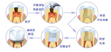 根管治疗后有哪些注意事项