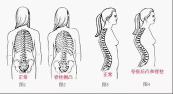 脊柱侧弯怀孕注意事项