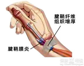 腱鞘炎打针后注意事项
