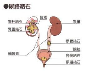 尿道,结石,注意事项,饮食