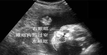 孕妇胎儿畸形几个月引产注意事项