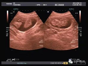 孕妇超声检查注意事项