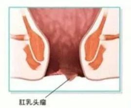 肛乳头肥大结扎术后注意事项