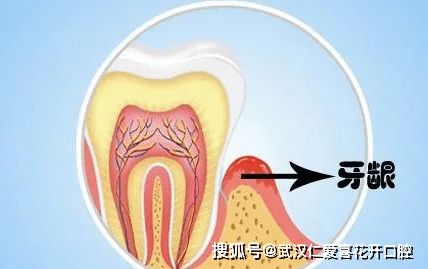 牙槽骨修整术的注意事项,牙及牙槽骨损伤结扎注意事项,牙槽骨钉注意事项