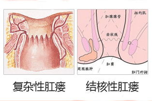 内瘘的术后护理及注意事项,动静脉内瘘的护理与注意事项,肛瘘术后护理注意事项