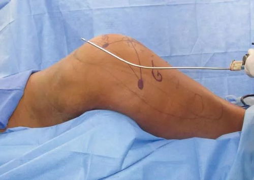 移植前的注意事项,移植后的注意事项,移植后注意事项和饮食