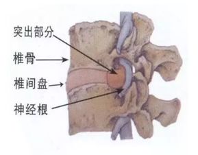 注意事项,患者,腰椎间盘突出