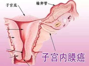 子宫内膜癌化疗注意事项
