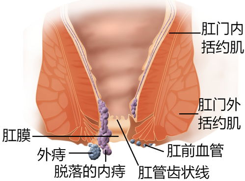 痔疮肛瘘术前术后注意事项