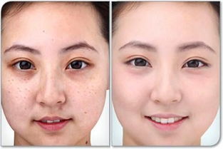 调q激光祛斑后注意事项