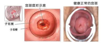 做完宫颈糜烂手术后注意事项