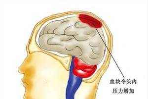 脑出血术后注意事项