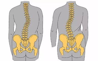 脊柱侧弯术后注意事项,脊柱侧弯日常生活注意事项,脊柱侧弯麻醉注意事项