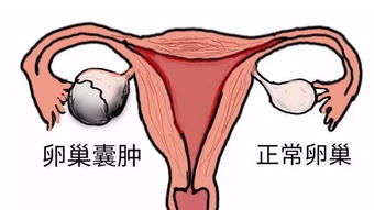 左侧卵巢囊肿注意事项