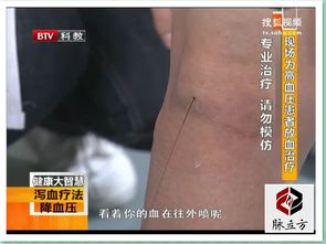 身体放血后注意事项