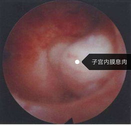 手术后,注意事项,宫腔镜