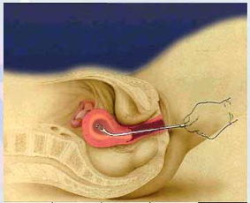 刮完子宫内膜需要注意什么,刮子宫内膜后注意事项和调理,子宫内膜刮宫术后注意事项