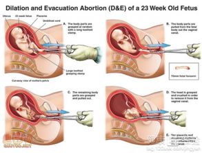 刮宫,无痛,注意事项