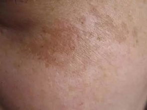 长痘痘洗脸怎么注意事项