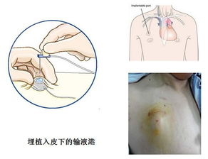 乳腺癌术前化疗注意事项,乳腺癌术后化疗注意事项,乳腺癌化疗后注意事项