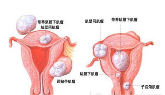 宫颈肌瘤术后注意事项