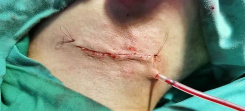 鳃裂囊肿术后注意事项,前庭大腺囊肿术后注意事项,会厌囊肿术后注意事项