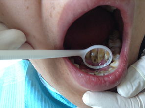 牙周翻瓣术病例书写,牙周脓肿的病例书写,急性牙周脓肿病例书写