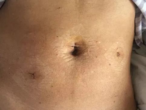 腹腔镜疝气修补术后的注意事项
