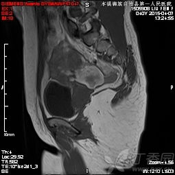 mri增强检查注意事项和禁忌症,mri增强检查后注意事项,增强mri检查需要注意事项