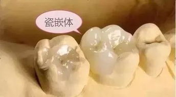 嵌体的适应症及临床注意事项