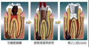 牙齿根充后的注意事项