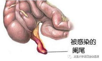 阑尾炎,开刀,注意事项