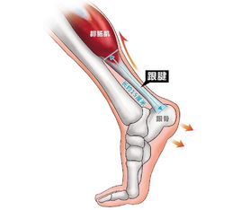 跟腱断裂手术前后注意事项