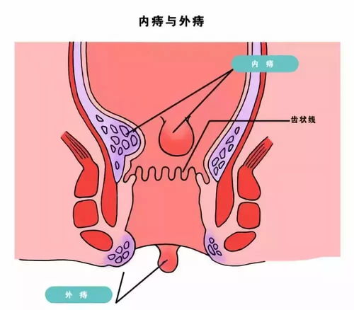 痔疮手术后应注意事项