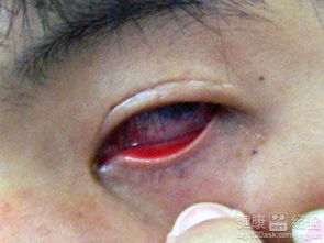 结膜炎注意事项和如何恢复,结膜炎一般多久能好结膜炎注意事项,结膜炎日常注意事项