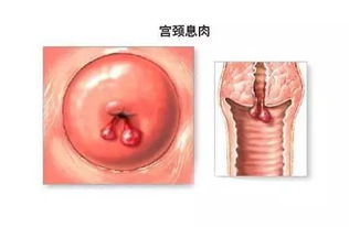 leep刀宫颈息肉手术后注意事项