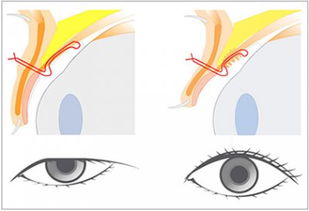 上睑下垂手术拆线后注意事项,上睑下垂矫正术后注意事项,上睑下垂术后饮食注意事项