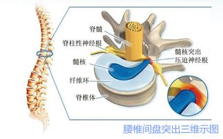 腰椎间盘突出症患者注意事项有哪些呢?,腰椎间盘突出症的注意事项,腰椎间盘突出症出院注意事项