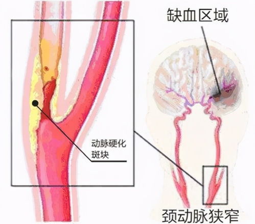 检查颈动脉注意事项