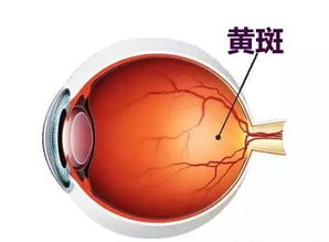 黄斑水肿有什么注意事项